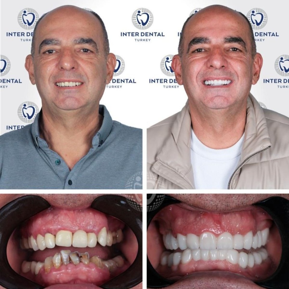 Resultados de implantes dentales antes y después en Inter Dental Turkey, sonrisa restaurada