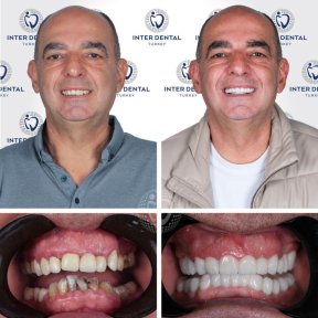 before-after photo dental-implant