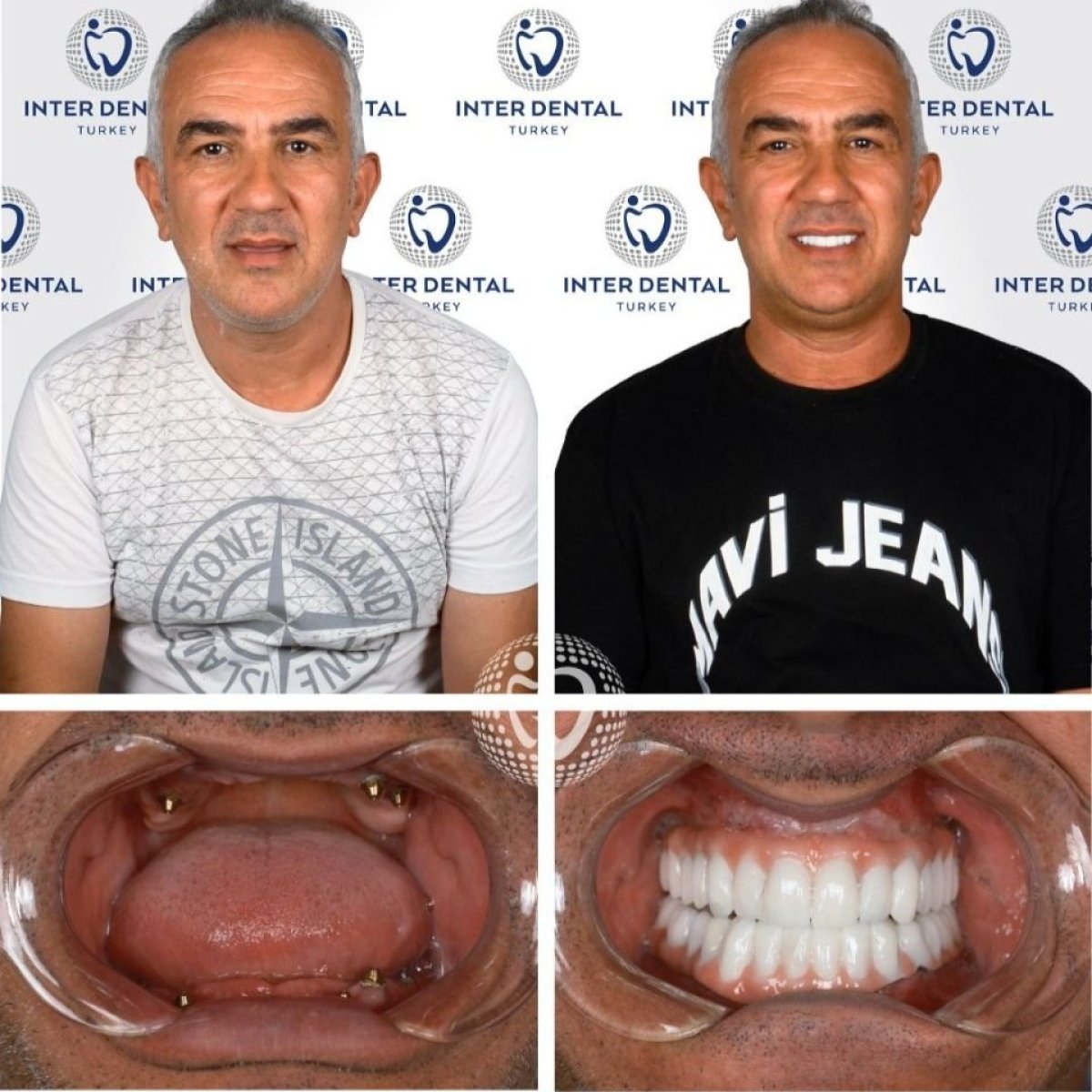 Resultados de implantes dentales antes y después en Inter Dental Turkey – sonrisa restaurada
