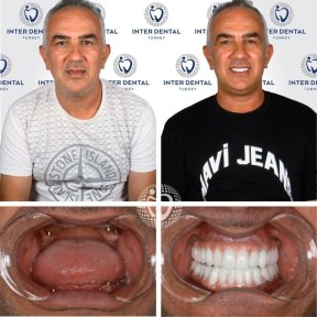 before-after photo dental-implant