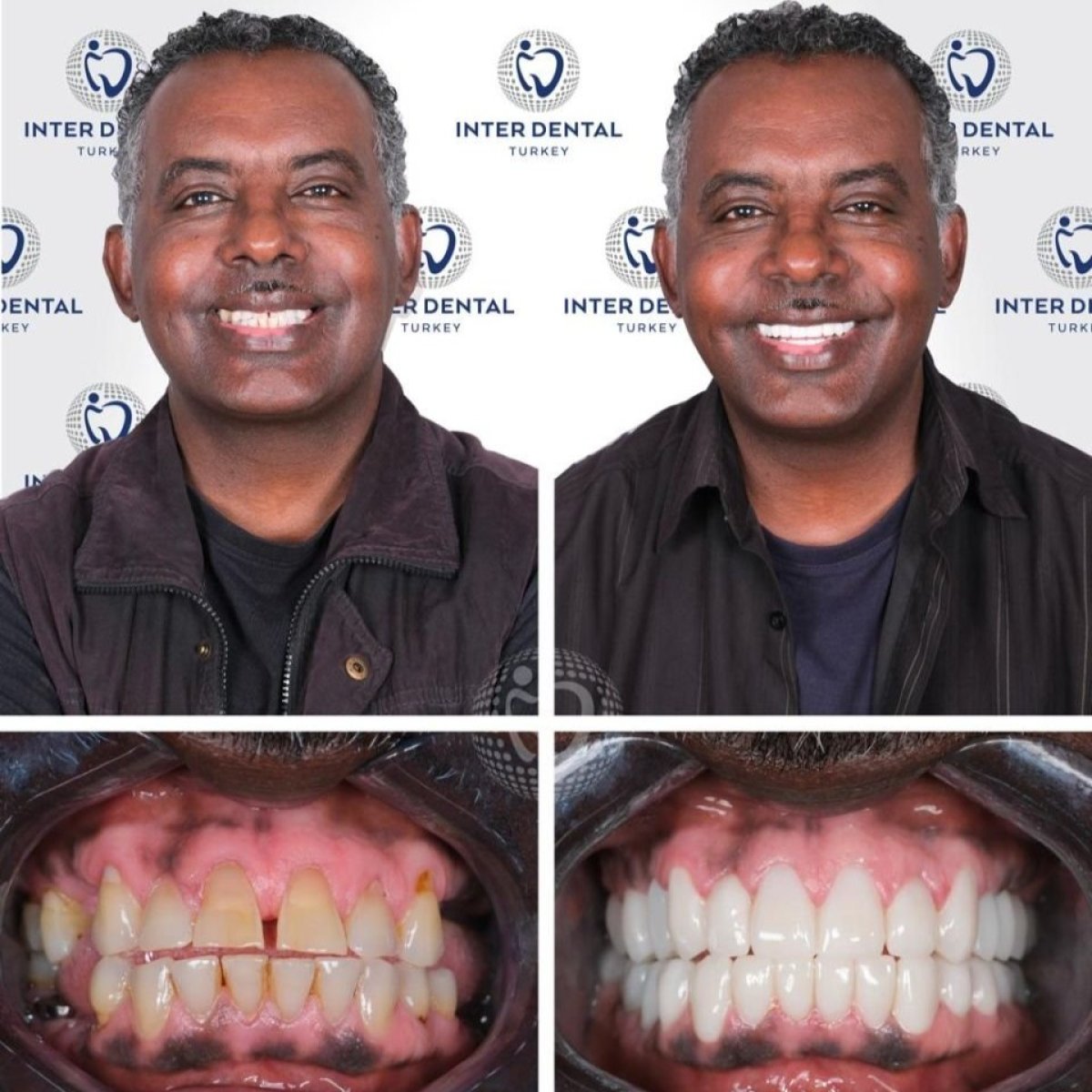 Resultados de implantes dentales antes y después en Inter Dental Turkey: sonrisa y alineación mejoradas