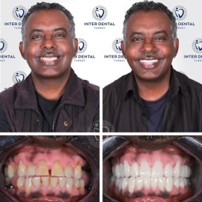 before-after photo dental-implant