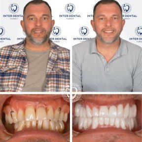 before-after photo dental-implant