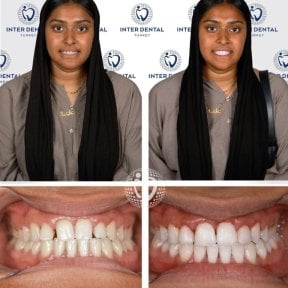 before-after photo tooth-restoration