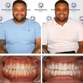 before-after photo tooth-restoration