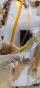 Plasmapheresis procedure in progress at Moderne Apherese | Modern Apheresis clinic result