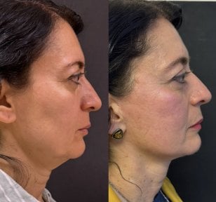 Before and after deep plane facelift results – improved jawline and neck contour