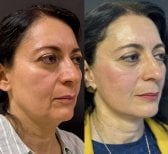 نتائج قبل وبعد شد الوجه العميق – تجديد شباب الوجه ورفع الملامح