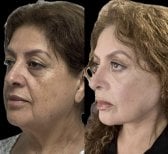Before and after Deep Plane Facelift results – visible facial rejuvenation and tighter jawline