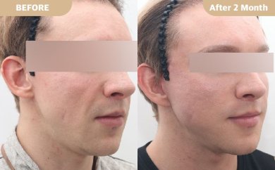 before-after photo deep-plane-facelift