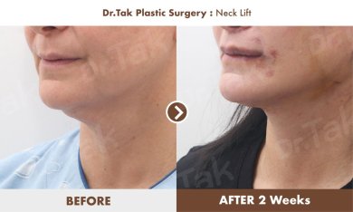 Before and after neck lift results at Dr. Tak Plastic Surgery, visible contour improvement