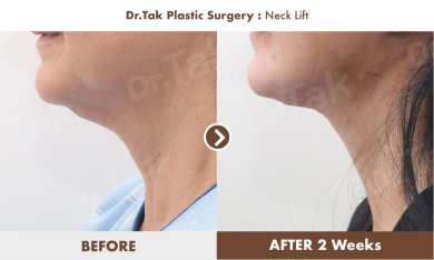 Before and after neck lift results at Dr. Tak Plastic Surgery, visible neck contour improvement