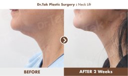 Before and after neck lift results at Dr. Tak Plastic Surgery, visible neck contour improvement