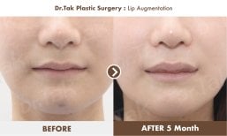 Before and after lip augmentation results at Dr. Tak Plastic Surgery, fuller lips after 5 months