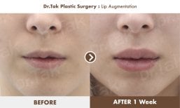 Before and after lip augmentation at Dr. Tak Plastic Surgery, fuller lips after 1 week result