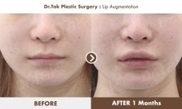 Before and after lip augmentation results at Dr. Tak Plastic Surgery, fuller lips after 1 month