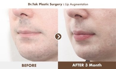 Before and after lip augmentation at Dr. Tak Plastic Surgery, fuller lips visible after 3 months