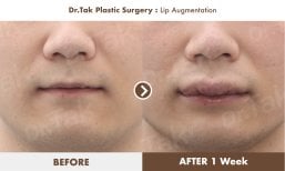Before and after lip augmentation results at Dr. Tak Plastic Surgery, fuller lips in 1 week