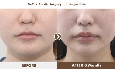 Before and after lip augmentation at Dr. Tak Plastic Surgery, fuller lips after 3 months