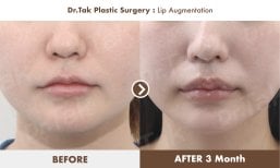 Before and after lip augmentation at Dr. Tak Plastic Surgery, fuller lips after 3 months