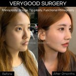 Résultats avant et après rhinoplastie de révision chez VG Plastic Surgery, contour du nez amélioré