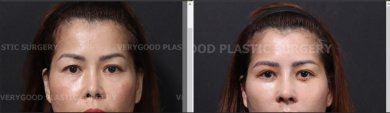 Lower eyelid blepharoplasty before and after results at VG Plastic Surgery, improved eye contour