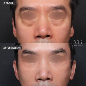 Lower eyelid blepharoplasty before and after results at VG Plastic Surgery, reduced eye bags