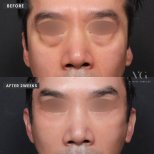 Lower eyelid blepharoplasty before and after results at VG Plastic Surgery, reduced eye bags