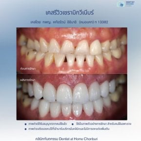Результат до і після встановлення вінірів у Dentist at home Clinic, Чонбурі – зміна посмішки