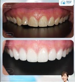 Результат до і після вінірування в Dentist at home Clinic, Чонбурі – білі рівні зуби