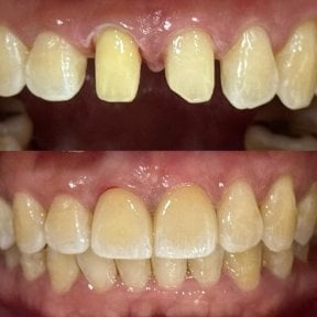 before-after photo dental-implant