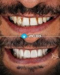 Przed i po licówkach w Inci Dis International – bielszy, równy uśmiech efekt