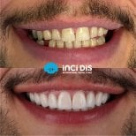 Przed i po licówkach w Inci Dis International, naturalna metamorfoza uśmiechu