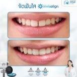 Resultados antes y después de Invisalign en Dentist at home, Bangkok: dientes más rectos