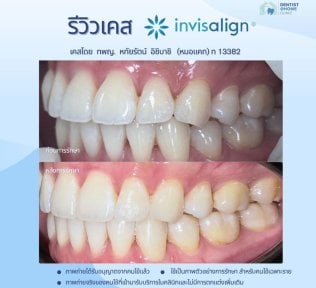 Результати до і після Invisalign у Dentist at home, Бангкок – вирівнювання зубів