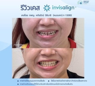 Результати до і після Invisalign у Dentist at home, Бангкок – вирівнювання зубів