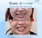Результати до і після Invisalign у Dentist at home, Бангкок – вирівнювання зубів