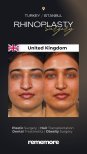 نتائج قبل وبعد عملية تجميل الأنف العرقية في مستشفى ميموريال باهجيليفلر، إعادة تشكيل الأنف