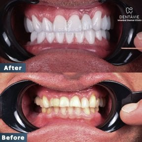 before-after photo implantacia-zuba