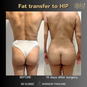 before-after photo brazilian-butt-lift