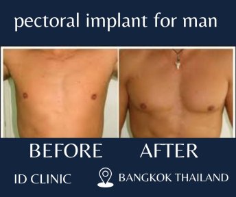 before-after photo brazilian-butt-lift