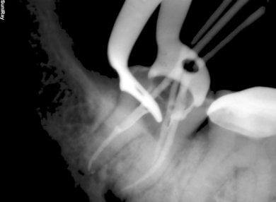 before-after photo treatment-of-caries