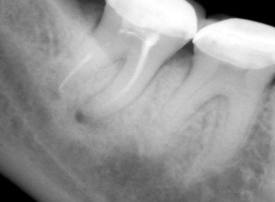before-after photo treatment-of-caries
