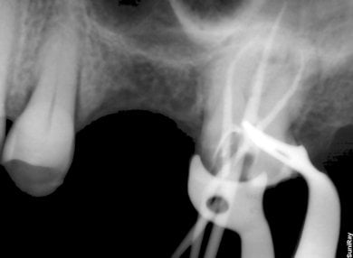 before-after photo treatment-of-caries