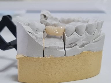 before-after photo treatment-of-caries