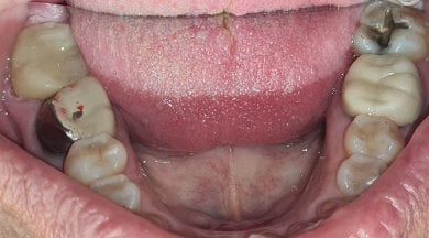 before-after photo treatment-of-caries
