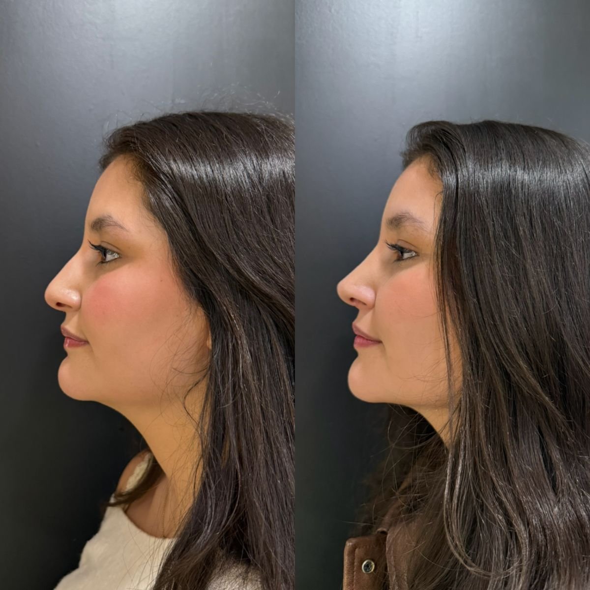 نتائج قبل وبعد عملية تجميل الأنف التصحيحية في عيادة Dr. Alexandro Aguilera - Plastic Surgery