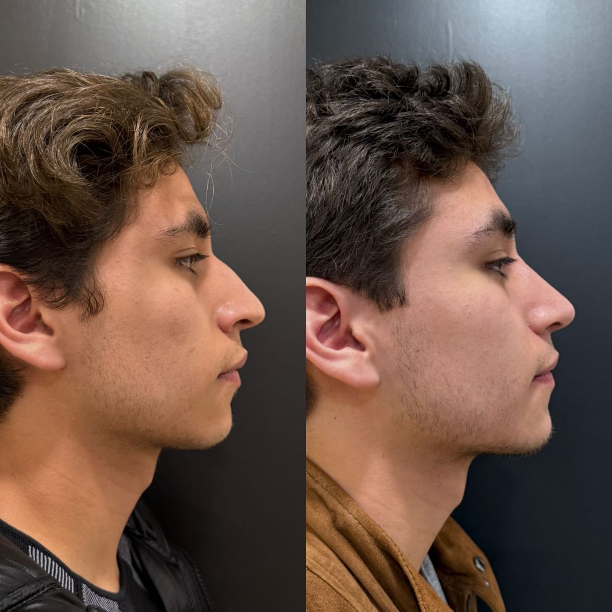 نتائج قبل وبعد عملية تجميل الأنف التصحيحية في عيادة Dr. Alexandro Aguilera - Plastic Surgery