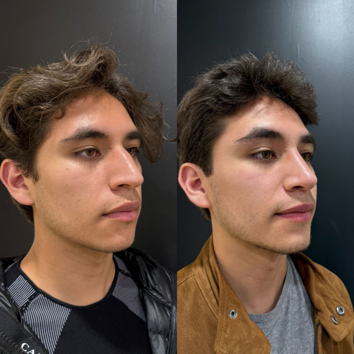 نتائج قبل وبعد عملية تجميل الأنف التصحيحية في عيادة Dr. Alexandro Aguilera - Plastic Surgery