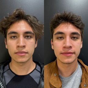 before-after photo revision-rhinoplasty